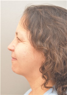 Facelift Before Photo by Keshav Magge, MD; Bethesda, MD - Case 38638
