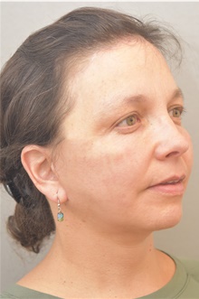 Neck Lift After Photo by Keshav Magge, MD; Bethesda, MD - Case 38639
