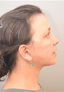Neck Lift After Photo by Keshav Magge, MD; Bethesda, MD - Case 38639