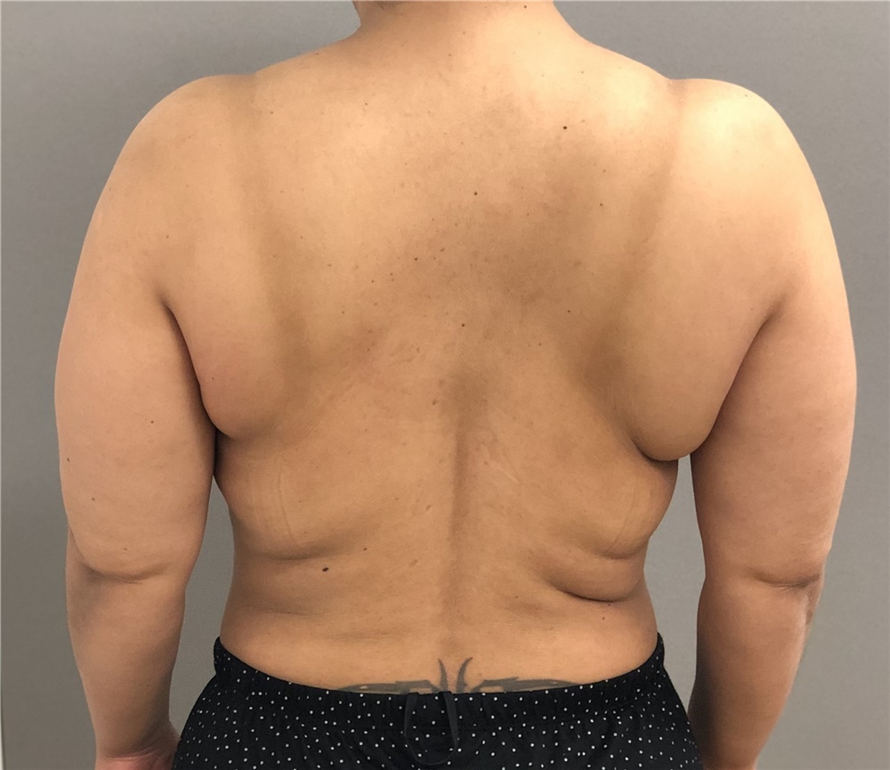 Body Contouring Before and After Photos by Keshav Magge, MD
