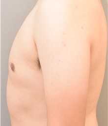 Male Breast Reduction After Photo by Keshav Magge, MD; Bethesda, MD - Case 38642