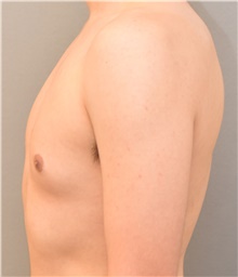 Male Breast Reduction Before Photo by Keshav Magge, MD; Bethesda, MD - Case 38642