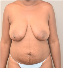 Tummy Tuck Before Photo by Keshav Magge, MD; Bethesda, MD - Case 38667