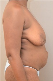 Tummy Tuck Before Photo by Keshav Magge, MD; Bethesda, MD - Case 38667