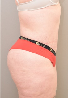 Tummy Tuck After Photo by Keshav Magge, MD; Bethesda, MD - Case 38668