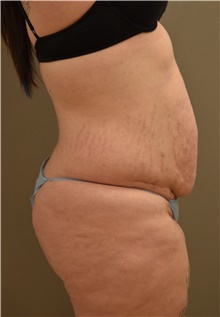 Tummy Tuck Before Photo by Keshav Magge, MD; Bethesda, MD - Case 38668
