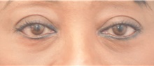 Eyelid Surgery After Photo by Keshav Magge, MD; Bethesda, MD - Case 39009