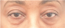 Eyelid Surgery Before Photo by Keshav Magge, MD; Bethesda, MD - Case 39009