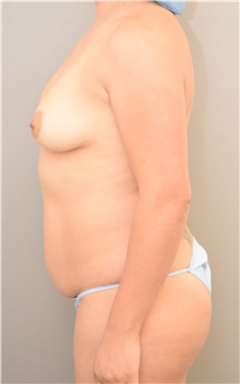 Tummy Tuck Before Photo by Keshav Magge, MD; Bethesda, MD - Case 39011