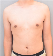 Male Breast Reduction After Photo by Keshav Magge, MD; Bethesda, MD - Case 39014