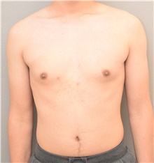 Male Breast Reduction Before Photo by Keshav Magge, MD; Bethesda, MD - Case 39014