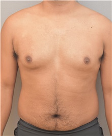 Male Breast Reduction Before Photo by Keshav Magge, MD; Bethesda, MD - Case 39182