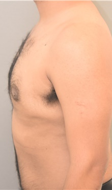Male Breast Reduction After Photo by Keshav Magge, MD; Bethesda, MD - Case 39182