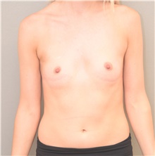 Breast Augmentation Before Photo by Keshav Magge, MD; Bethesda, MD - Case 39183