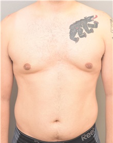Male Breast Reduction After Photo by Keshav Magge, MD; Bethesda, MD - Case 39184