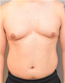 Male Breast Reduction Before Photo by Keshav Magge, MD; Bethesda, MD - Case 39184