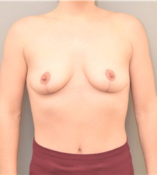 Breast Lift After Photo by Keshav Magge, MD; Bethesda, MD - Case 39186