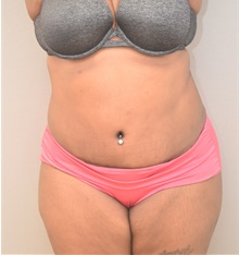 Tummy Tuck After Photo by Keshav Magge, MD; Bethesda, MD - Case 39351