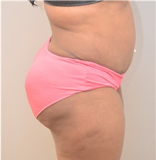 Tummy Tuck After Photo by Keshav Magge, MD; Bethesda, MD - Case 39351