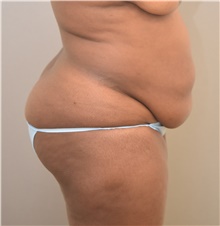 Tummy Tuck Before Photo by Keshav Magge, MD; Bethesda, MD - Case 39351