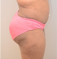 Buttock Lift with Augmentation After Photo by Keshav Magge, MD; Bethesda, MD - Case 39352