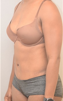 Tummy Tuck After Photo by Keshav Magge, MD; Bethesda, MD - Case 39371