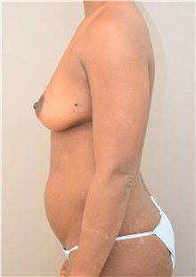 Tummy Tuck Before Photo by Keshav Magge, MD; Bethesda, MD - Case 39371