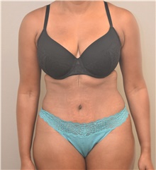 Tummy Tuck After Photo by Keshav Magge, MD; Bethesda, MD - Case 39372