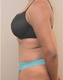 Tummy Tuck After Photo by Keshav Magge, MD; Bethesda, MD - Case 39372