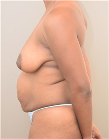 Tummy Tuck Before Photo by Keshav Magge, MD; Bethesda, MD - Case 39372