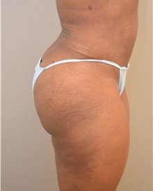Buttock Lift with Augmentation After Photo by Keshav Magge, MD; Bethesda, MD - Case 39384