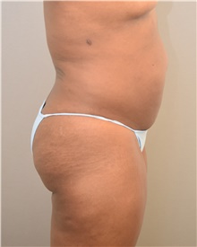 Buttock Lift with Augmentation Before Photo by Keshav Magge, MD; Bethesda, MD - Case 39384