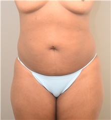 Liposuction Before Photo by Keshav Magge, MD; Bethesda, MD - Case 39385