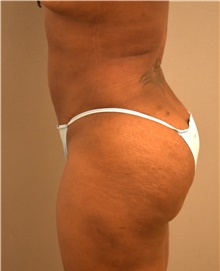 Liposuction After Photo by Keshav Magge, MD; Bethesda, MD - Case 39385