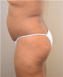 Liposuction Before Photo by Keshav Magge, MD; Bethesda, MD - Case 39385