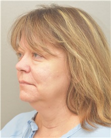 Facelift Before Photo by Keshav Magge, MD; Bethesda, MD - Case 39389
