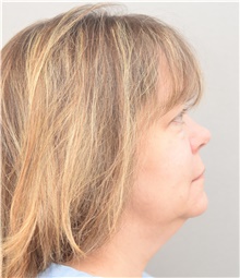 Facelift Before Photo by Keshav Magge, MD; Bethesda, MD - Case 39389