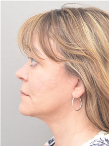 Neck Lift After Photo by Keshav Magge, MD; Bethesda, MD - Case 39390