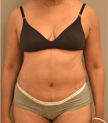 Tummy Tuck After Photo by Keshav Magge, MD; Bethesda, MD - Case 39391