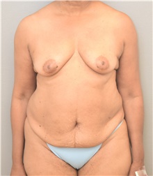 Tummy Tuck Before Photo by Keshav Magge, MD; Bethesda, MD - Case 39391