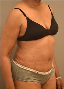 Tummy Tuck After Photo by Keshav Magge, MD; Bethesda, MD - Case 39391