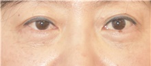 Eyelid Surgery After Photo by Keshav Magge, MD; Bethesda, MD - Case 39392
