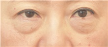 Eyelid Surgery Before Photo by Keshav Magge, MD; Bethesda, MD - Case 39392