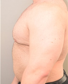 Male Breast Reduction After Photo by Keshav Magge, MD; Bethesda, MD - Case 39393