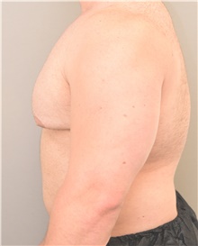 Male Breast Reduction Before Photo by Keshav Magge, MD; Bethesda, MD - Case 39393