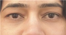 Eyelid Surgery After Photo by Keshav Magge, MD; Bethesda, MD - Case 39394