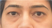 Eyelid Surgery Before Photo by Keshav Magge, MD; Bethesda, MD - Case 39394