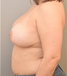 Breast Lift After Photo by Keshav Magge, MD; Bethesda, MD - Case 39402