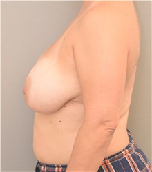 Breast Lift Before Photo by Keshav Magge, MD; Bethesda, MD - Case 39402