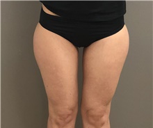 Liposuction After Photo by Keshav Magge, MD; Bethesda, MD - Case 39404